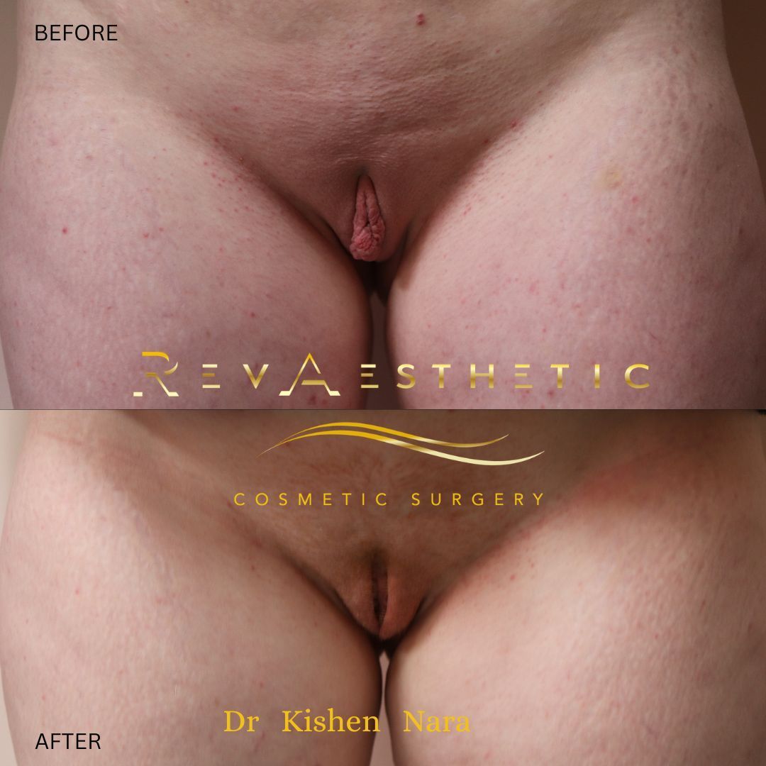 SAP labiaplasty — after
